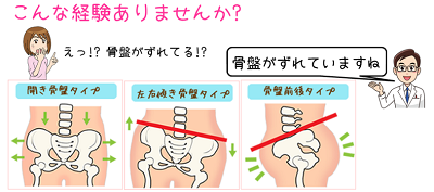 骨盤の開き　タイプ